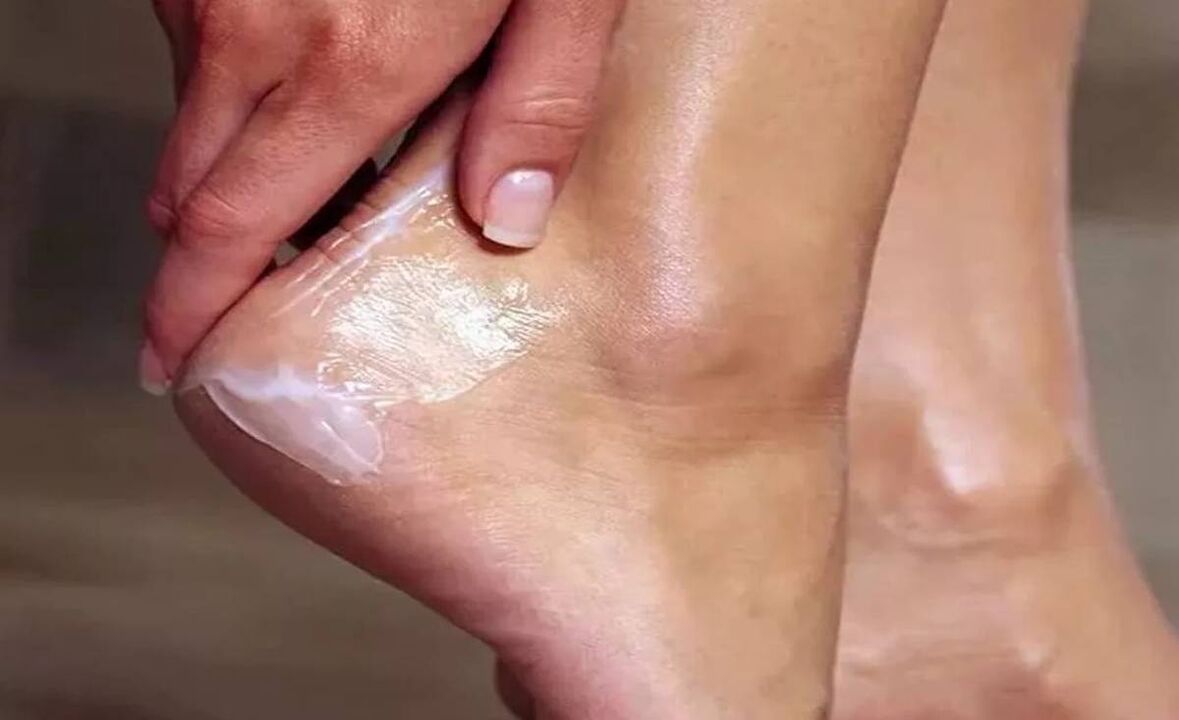 Cómo tratar los hongos en los pies con la crema Fungent