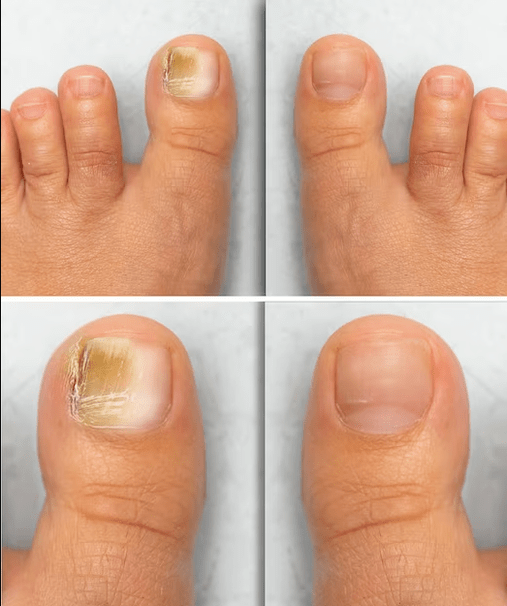 Hongos en los pies antes y después del tratamiento con crema Fungent