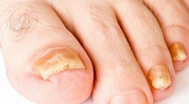 Cómo tratar el hongo de las uñas