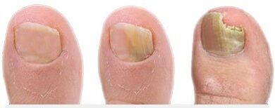 Etapas del desarrollo de hongos en las uñas