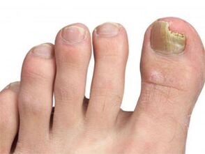 manchas amarillas en las uñas de la señal de los pies del hongo