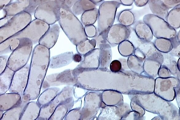 células de hongos en las uñas bajo un microscopio