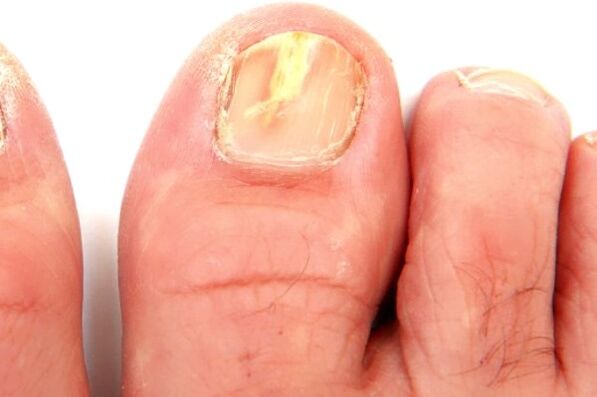 daño a la placa de la uña debido a una infección por hongos