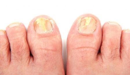 Manifestaciones de hongos en las uñas de los pies.