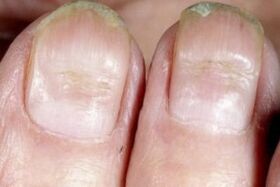 síntomas de hongos en las uñas