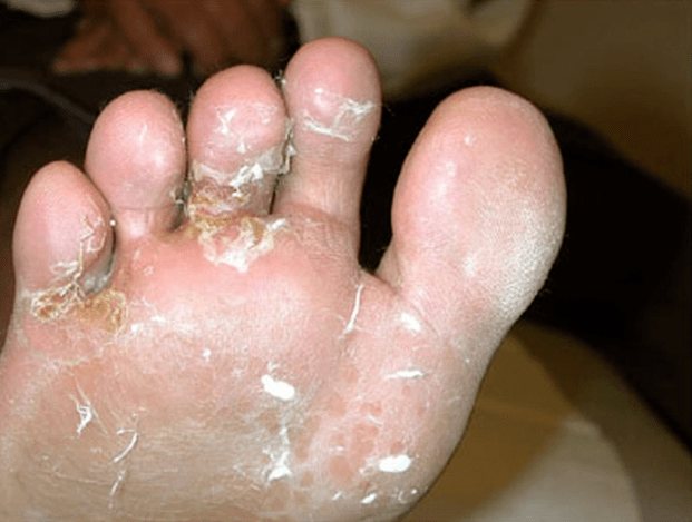 desarrollo de hongos en los dedos de los pies