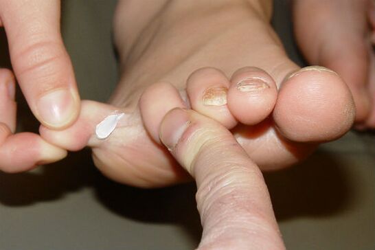 hongos entre los dedos de los pies