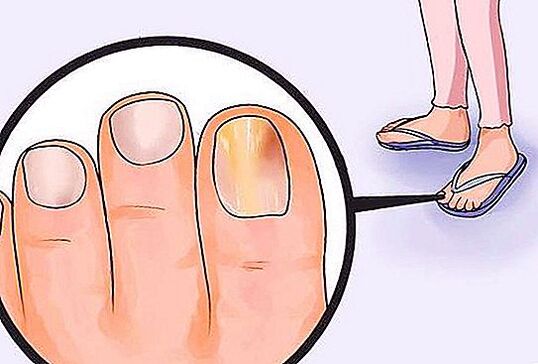hongos en las uñas de los pies