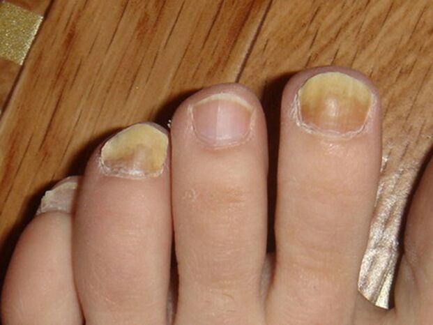síntomas de hongos en las uñas de los pies