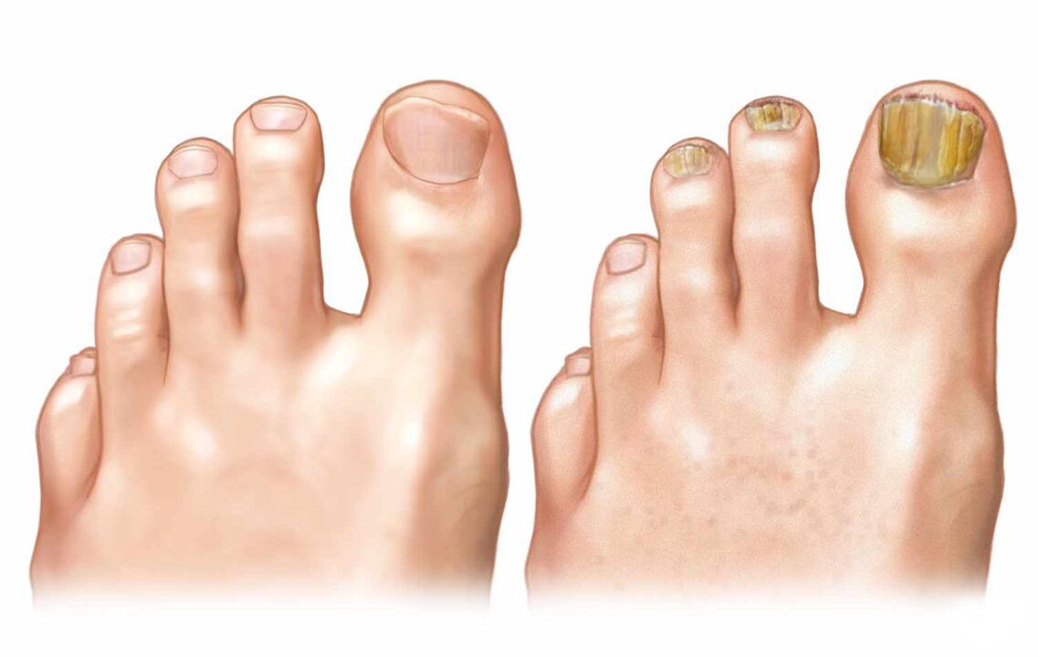 uñas sanas y hongos en las uñas de los pies