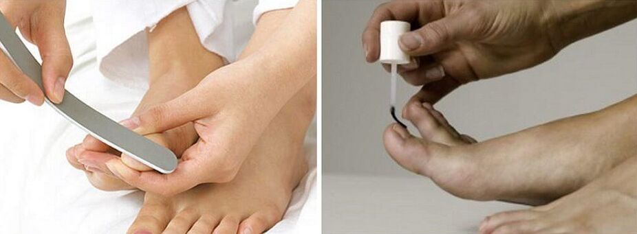 tratamiento de hongos en las uñas de los pies con barniz