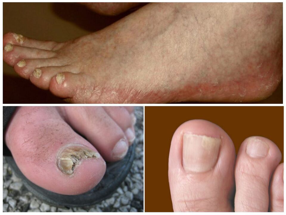 Tipos de hongos en los pies