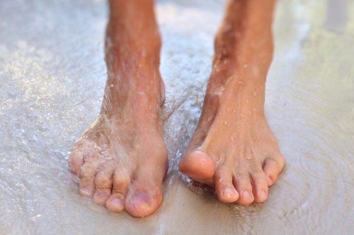Caminar descalzo como forma de contraer hongos en las uñas